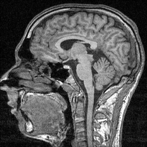 An FMRI scan of a brain. ERIK1980/WIKIMEDIA COMMONS VIA CC BY SA 3.0